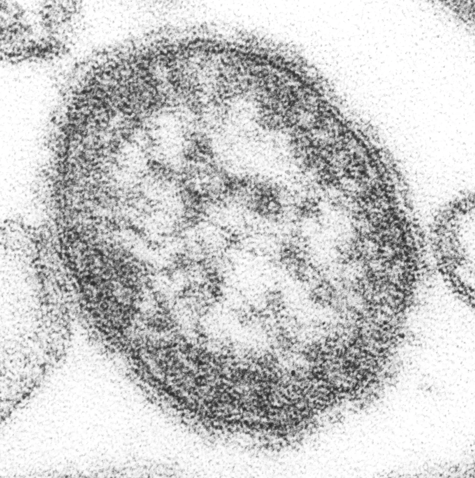 Nova York declara estado de emergência por surto de sarampo